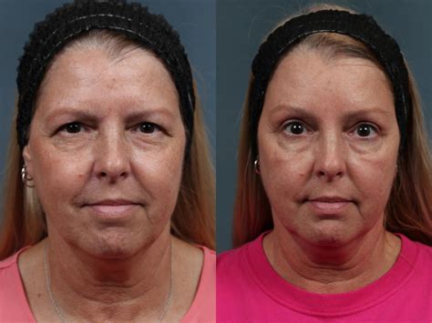 Brow/Forehead Lift Before & After Photo Gallery | Louisville, KY | CaloSpa® Rejuvenation Center