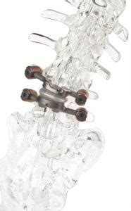 FDA approves IDE study for Premia Spine's TOPS™ System