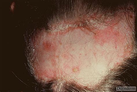 6-15-2 Discoid lupus erythematosus of the scalp with scarring alopecia