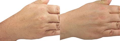 Are your hands making you look older?