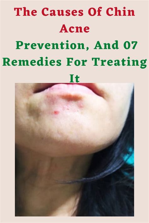 The Causes Of Chin Acne, Prevention, And 07 Remedies For Treating It ...