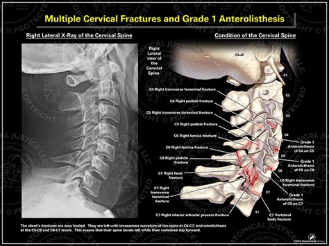 Multiple Cervical Fractures and Grade 1 Anterolisthesis