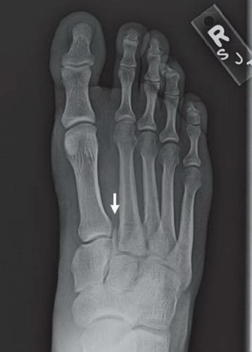 Lisfranc Fracture-Dislocation | Radiology Key