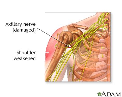 Axillary Nerve Damage