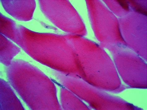 A cross-section of the ischemic muscle (×400): signs of a myomalacia of... | Download Scientific ...