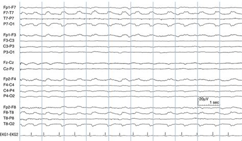 EEG Patterns in Stupor and Coma | Neupsy Key