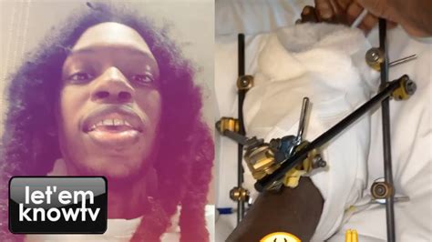 Rapper Julio Foolio Shows The Current State Of His Foot After Getting ...