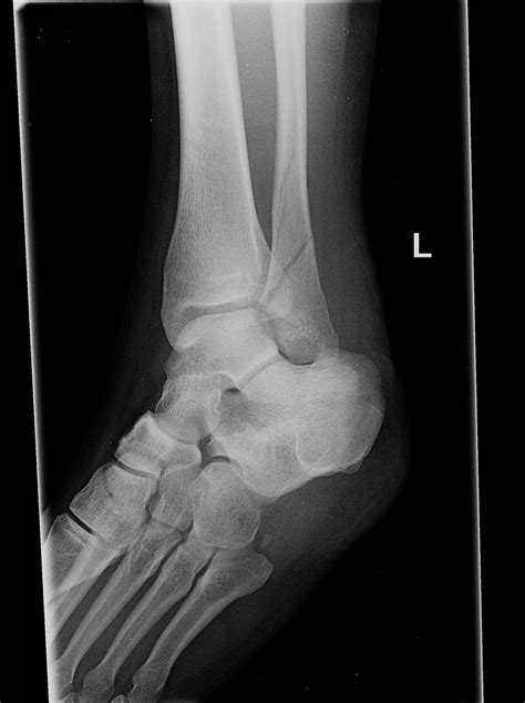 Distal Fibula Fracture Buyxraysonline | My XXX Hot Girl