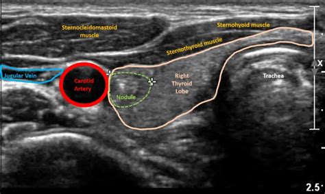 Thyroid Ultrasound: Purpose and Procedure | Healthtian