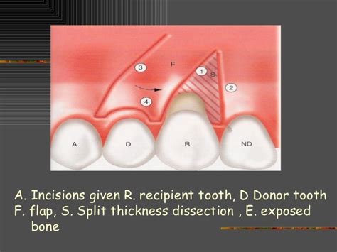 Lateral pedical graft