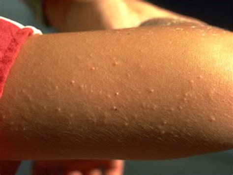 Keratosis Pilaris - Pictures, Symptoms, Causes, Treatment, Home Remedies