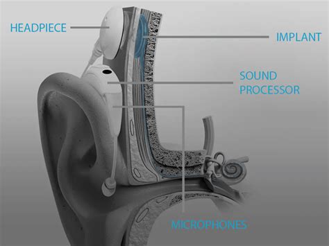 Discovering How a Cochlear Implant Sounds: Advanced Features from Advanced Bionics - Cochlear ...