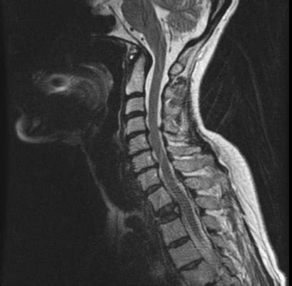 Osteoporosis X-ray - wikidoc