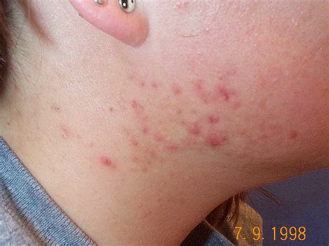 Celiac Disease, Gluten Sensitivity and Skin Issues