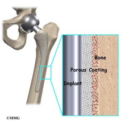 Hip Hemiarthroplasty | Houston Methodist