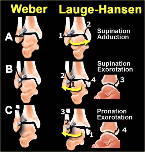 Ankle fracture - Weber and Lauge-Hansen Classification | Ankle fracture, Radiology imaging ...