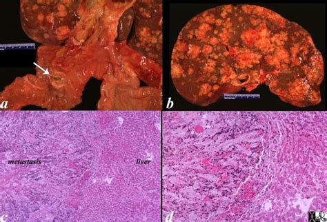 Liver Metastases | Disease