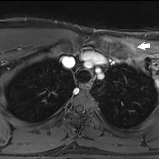 Desmoid tumor patient following surgical resection and cryoablation of... | Download Scientific ...