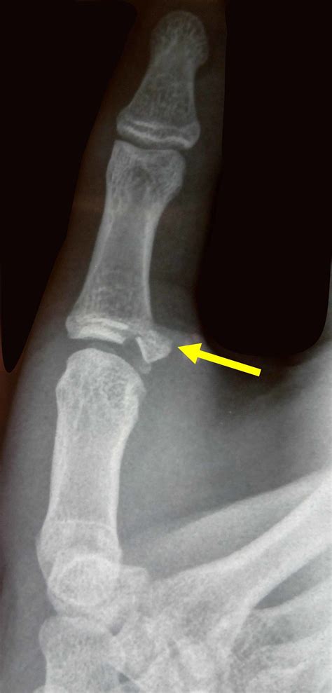 Ulnar Collateral Ligament Thumb