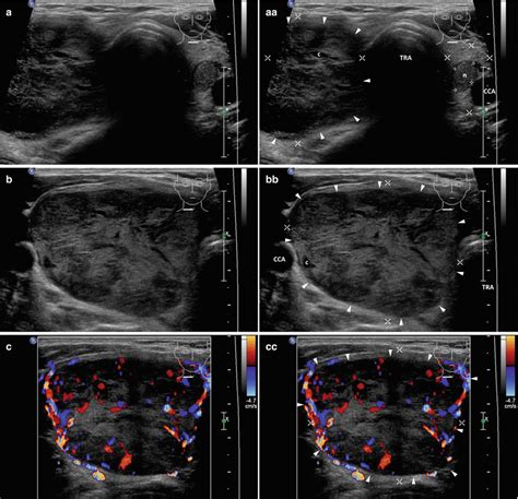 Multinodular Goiter Ultrasound