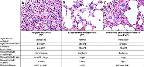 Myeloproliferative Neoplasms: Diagnostic Workup Of The, 51% OFF