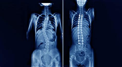 Spinal Deformity Symptoms & Treatments