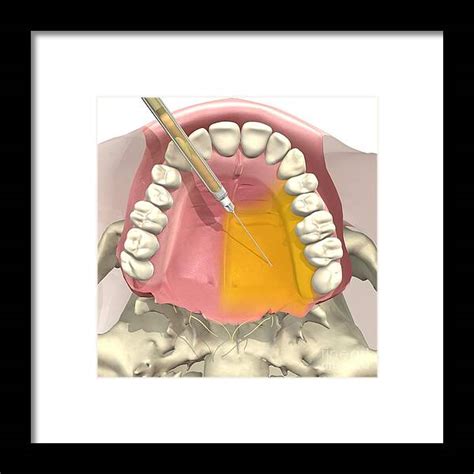 Greater Palatine Nerve Block Framed Print by Medical Images, Universal Images Group