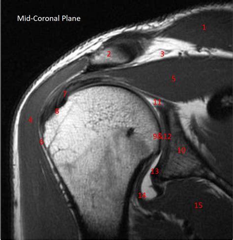 Shoulder MRI Mid-Coronal Plane Diagram | Quizlet