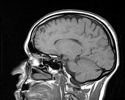 Neuroglial cyst | Image | Radiopaedia.org