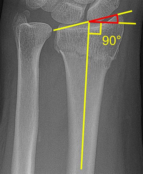 Distal radius fracture x ray - wikidoc