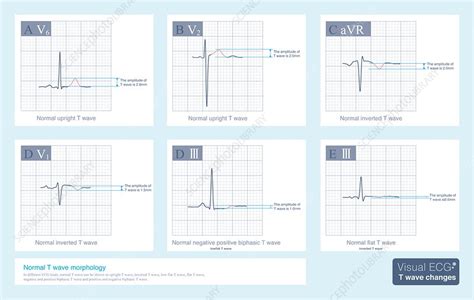 Normal T wave morphology, illustration - Stock Image - C053/0195 - Science Photo Library