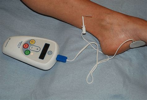 Posterior tibial nerve stimulation | Download Scientific Diagram