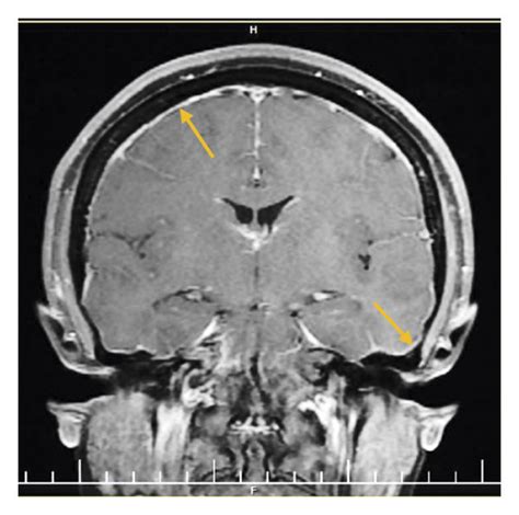 Brain MRI of patient demonstrating (a) cerebellar tonsillar herniation ...