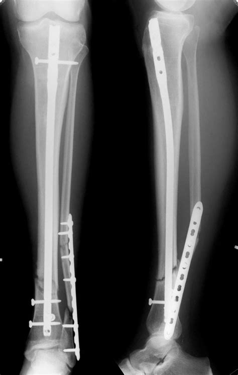 Tibia compression fracture treatment - partnersgola