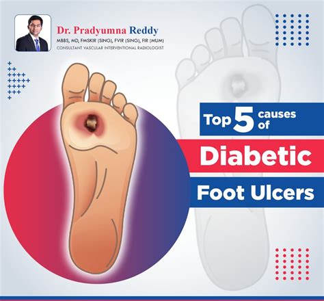 Top 5 causes of Diabetic Foot Ulcers