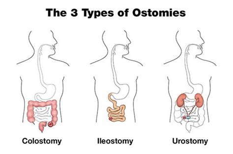 A Guide to Ostomy and Stoma Care - Homage Malaysia