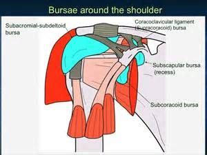 Subdeltoid Bursitis Shoulder