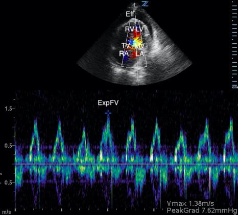 An Atypical Presentation: Cardiac Tamponade and the Value of Point-of ...