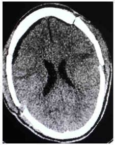 NCCT head (Postoperative) | Download Scientific Diagram