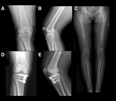 Return to Work Following High Tibial Osteotomy With Concomitant ...