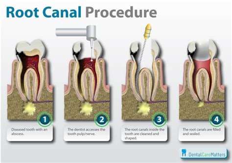 root-canals - Smiles Dental Docs Moncton