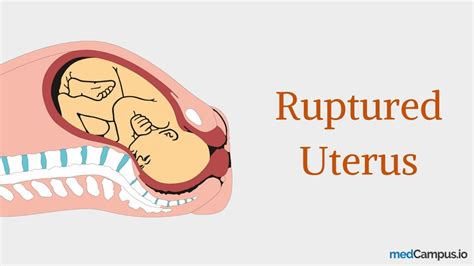 Uterine Rupture