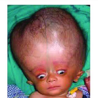 Image of a child with Alexander syndrome with hydrocephalus and... | Download Scientific Diagram