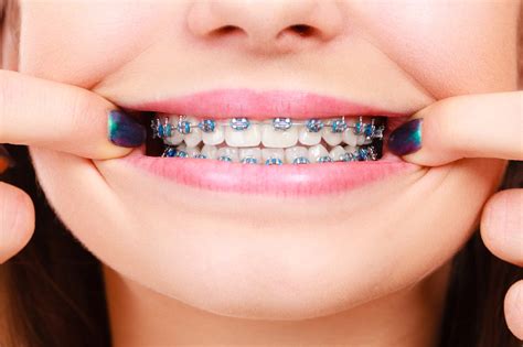 Metal, Clear or Invisible Braces | Harrison & Cincinnati, OH | Boley Braces