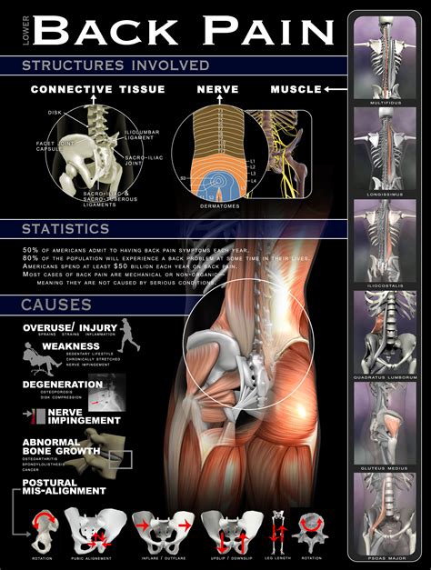 Back Pain Poster 18x24 - Real Bodywork Health Info, Health Benefits ...