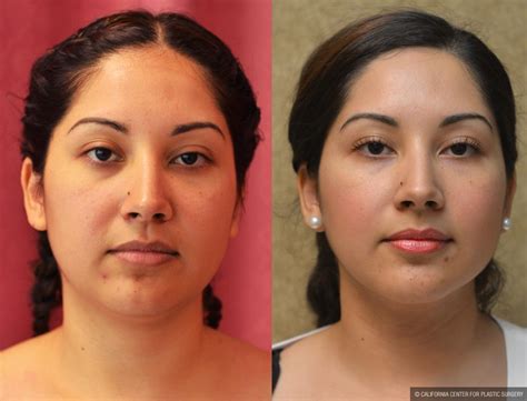 Patient #11005 Neck & Face Liposuction Before and After Photos Encino ...