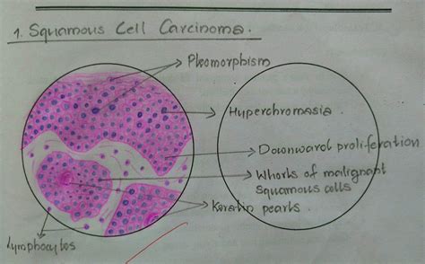 Histopathology Drawings: Squamous Cell Carcinoma