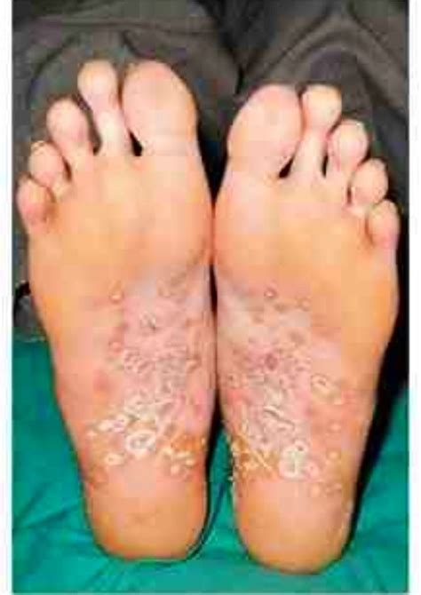 Keratoderma blennorrhagicum NEJM Dr Mustapha Tahir | Medical, Ouch, Podiatry