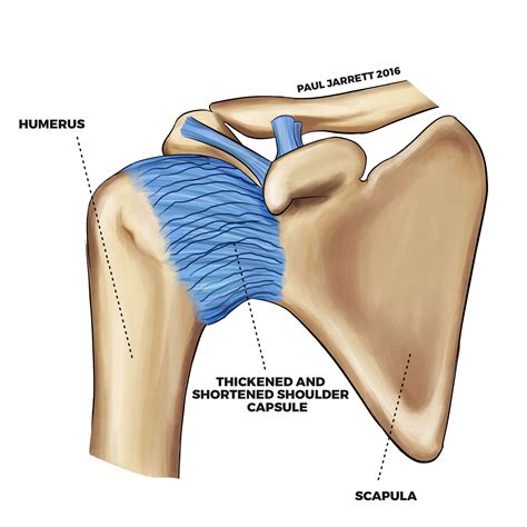 What Is A Capsular Pattern