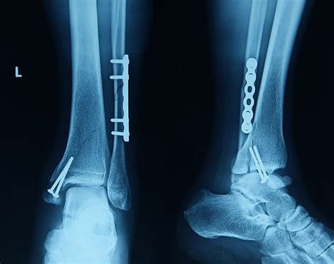 FOOT ANKLE SURGERY | AFAS Affiliated Foot & Ankle Surgeons